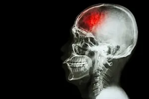 Brain Injury from a Vehicle Accident